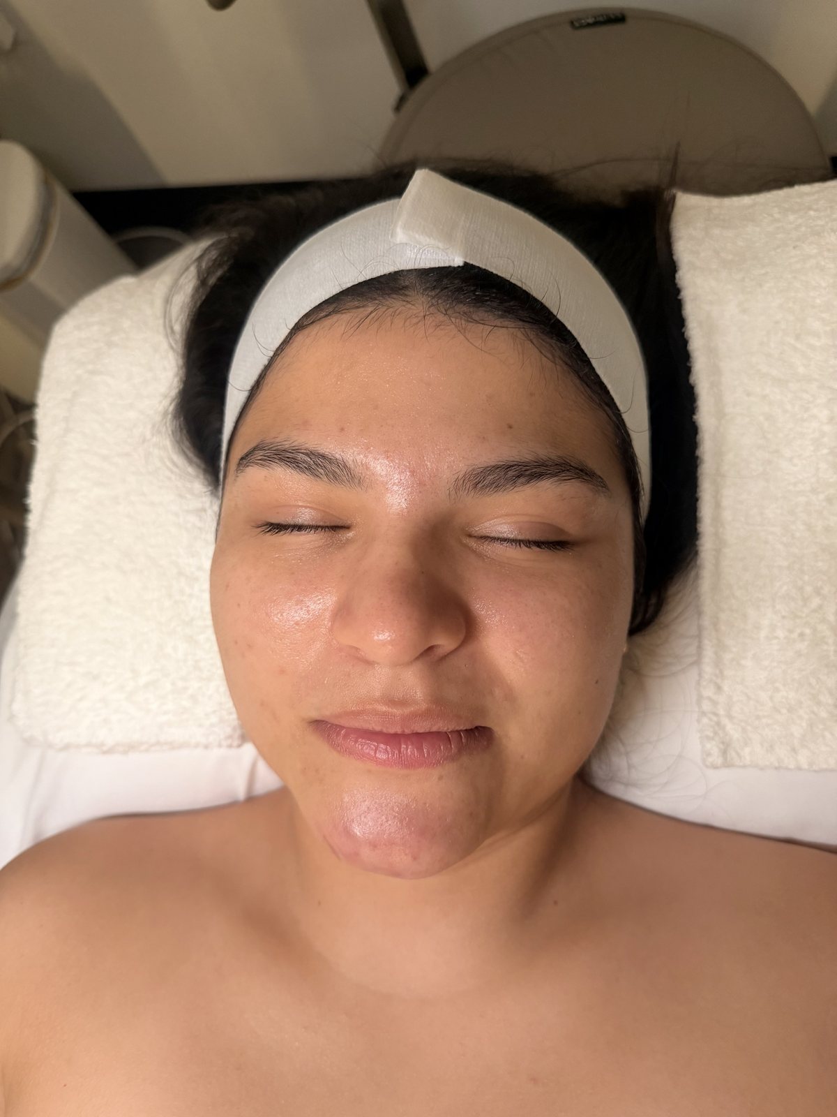 Resultado después del facial